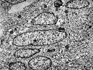 F, 45y. | necrobiosis lipoidica F, 45y. | necrobiosis lipoidica